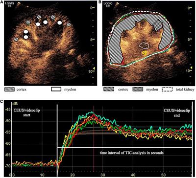 Factors influencing the time-intensity curve analysis of contrast-enhanced ultrasound in kidney transplanted patients: Toward a standardized contrast-enhanced ultrasound examination